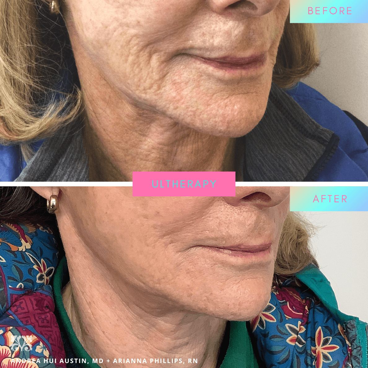 Ultherapy before and after